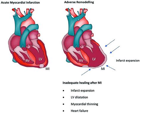 aging decreases post-infarction lv dilation